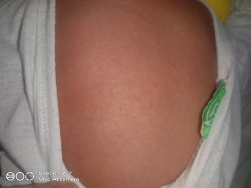 Pwede po ba pabakunahan si baby kahit may skin rushes sya? 2 months palang po si baby next week..
