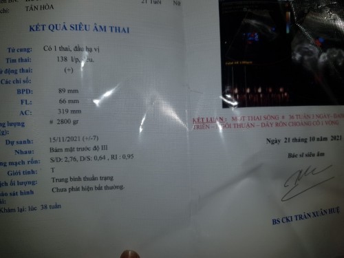 . Cho em hỏi bé bị quắn cổ 1 vòng nhưng mà bs nói quắn lơi à , không sao . . Vậy có cách nào cho