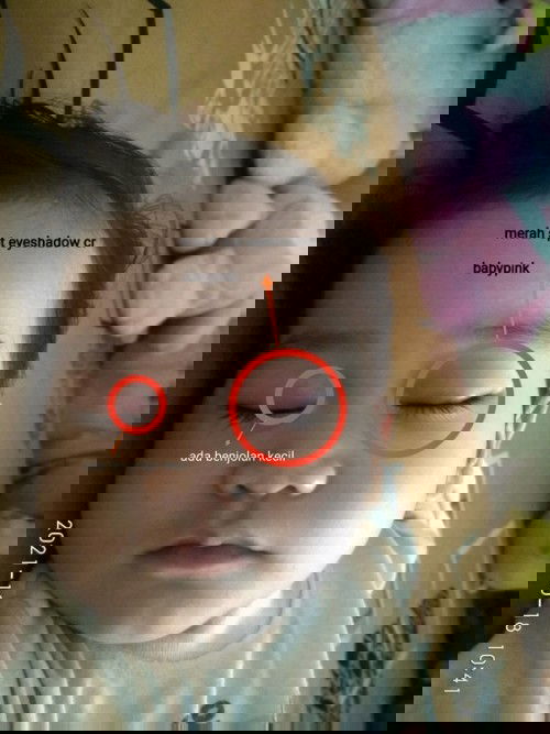 Kelopak mata bengkak