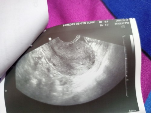 5weeks ultrasound