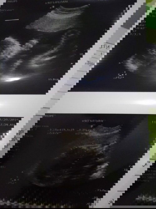 Normalkah BB janin saya?