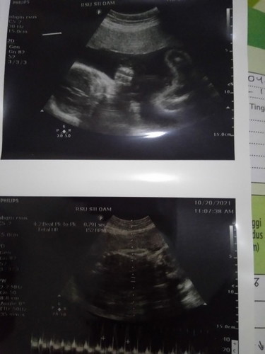 Normalkah BB janin saya?