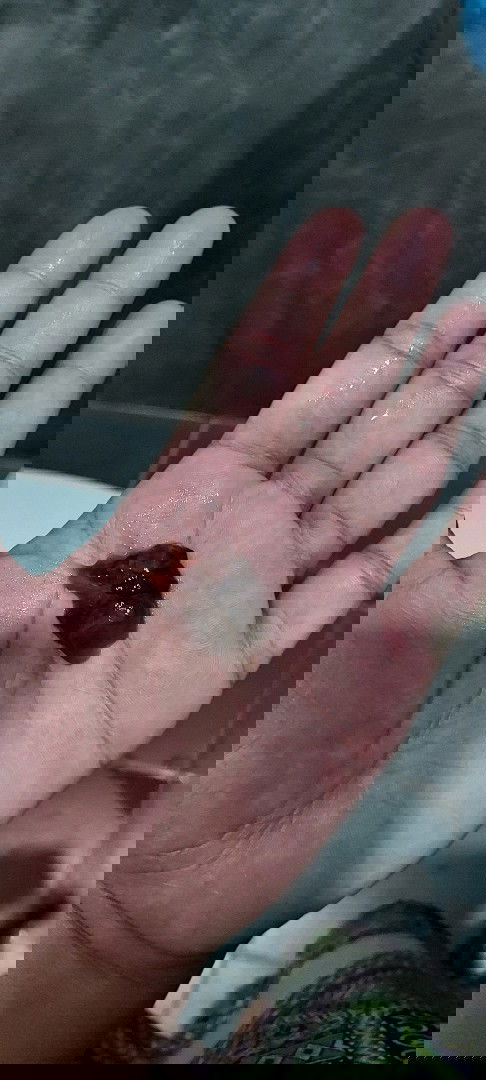 วันนี้หมอกระตุ้นปากมดลูกให้