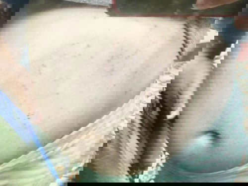 แม่ๆท่านไหนมีผื่นหรือตุ่มแดงขึ้นแบบนี้ไหม เกิดจากอะไร?