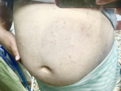 แม่ๆท่านไหนมีผื่นหรือตุ่มแดงขึ้นแบบนี้ไหม เกิดจากอะไร?