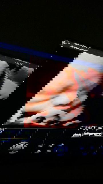 USG pas usia kandungan 7 bln,  jk cwo, apa masih bisa berubah ya bun?  Sharing pengalamannya dong