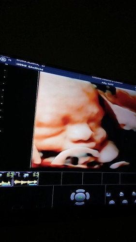 USG pas usia kandungan 7 bln, jk cwo, apa masih bisa berubah ya bun? Sharing pengalamannya dong