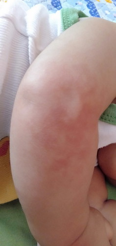 Kulit merah kehitaman