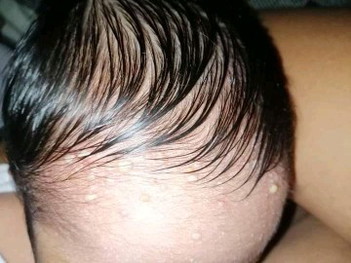 Tanong lang mga mommy's ano po kaya ito tumtubo sa nuo ng baby ko nawoworry na kasi ako