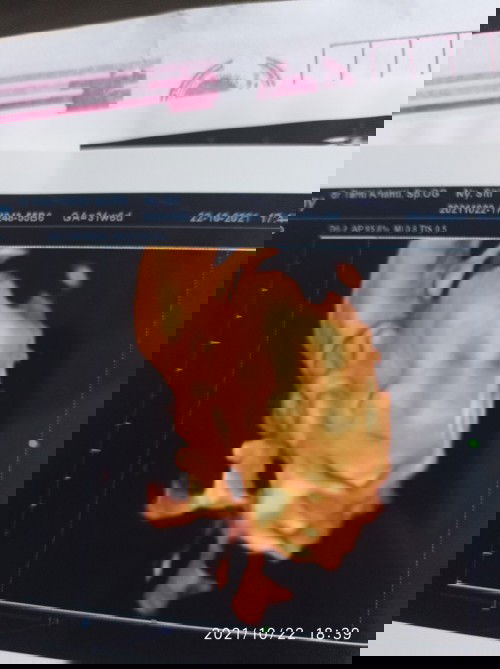 Posisi janin sungsang