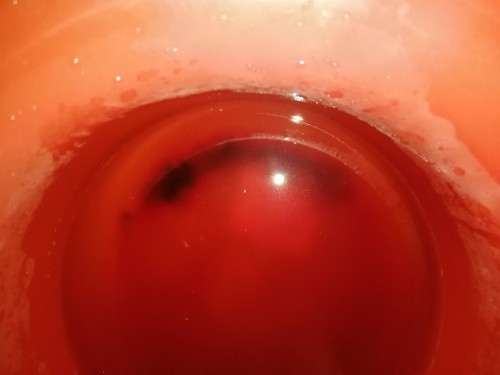 ขอถามแม่ๆที่ผ่าคลอดหน่อยค่ะ