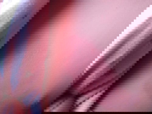 Vết bỏng của bé