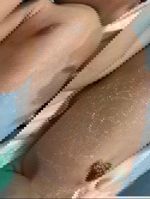 ผิวลูกลอกปกติไหม