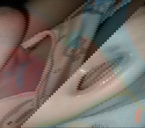 Bekas gigitan nyamuk/semut