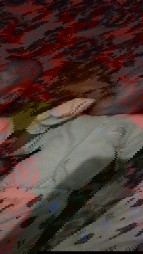 Bun anak saya wajahnya belang2 setelah sembuh dari bintik2 seperti ruam