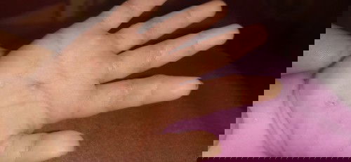 Bintik kecil lalu menghitam