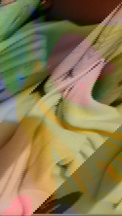 Tangan anak ku ada bercak warna merah