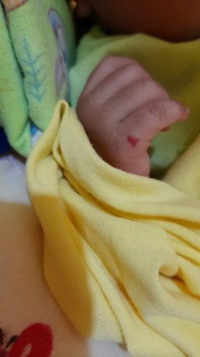 Tangan anak ku ada bercak warna merah