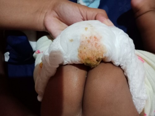 Apa ini poop darah bund??