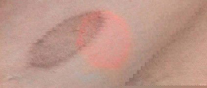 gatal berbentuk lingkaran