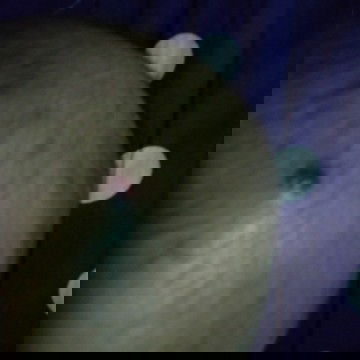 ตุ่มเลือดที่หัวทารก