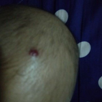 ตุ่มเลือดที่หัวทารก