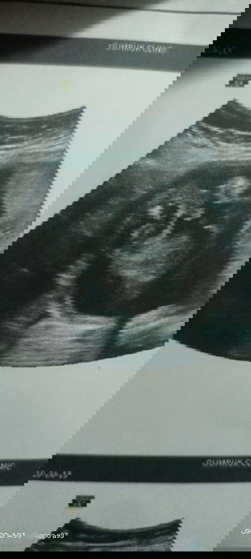 ดูเพศในใบอัตตร้าซาวด์🙂🤰