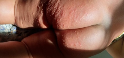 Kondisi kulit bayi 2 bulan 10 hari