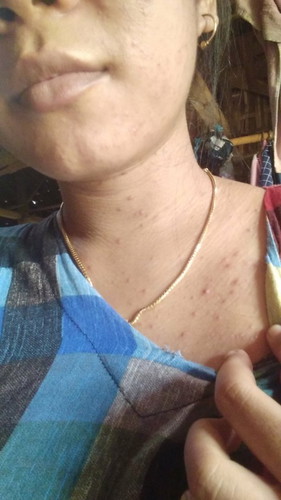 Bun apa obat biang keringat. Untuk ibu hamil