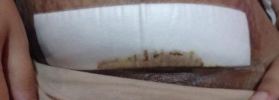 luka sc ini infeksi kah ?