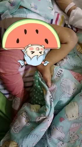 Embolisasi pada Hemangioma