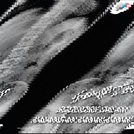 Kenali Simptom Sciolosis Dalam Kalangan Kanak-Kanak!