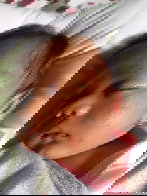 Cacar air diobati pakai apa bun. Bayiku 20 hari 😭..? 'Kàsian seluruh tbh bintil" Merah