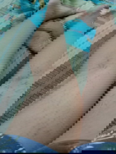 มีใครขาแตกแบบนี้บ้างมั้ยคะ