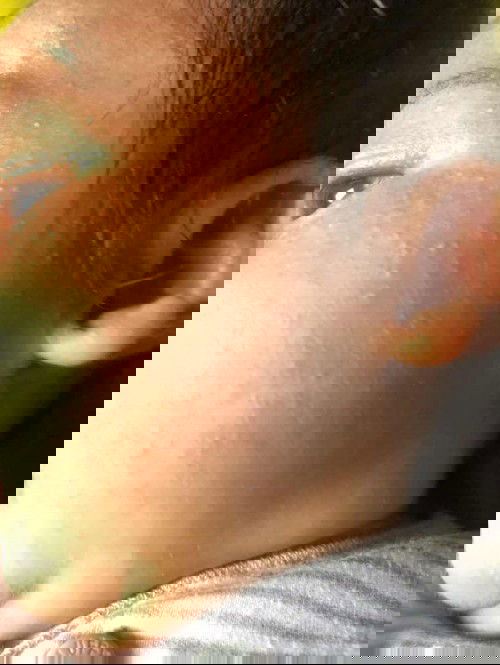 Beruntusan krna milea atau alergi makanan atau sufor ?