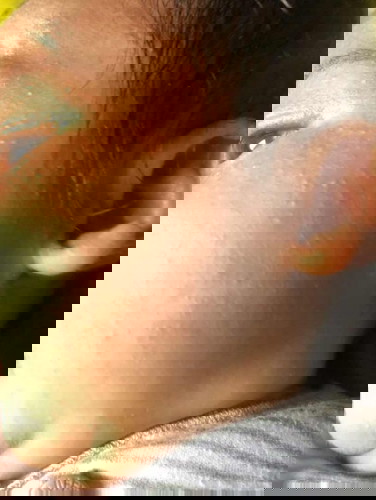 Beruntusan krna milea atau alergi makanan atau sufor ?