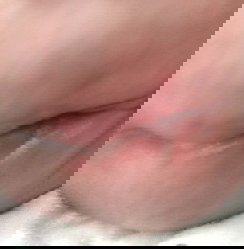 น้องน่าจะแพ้แพมเพิด