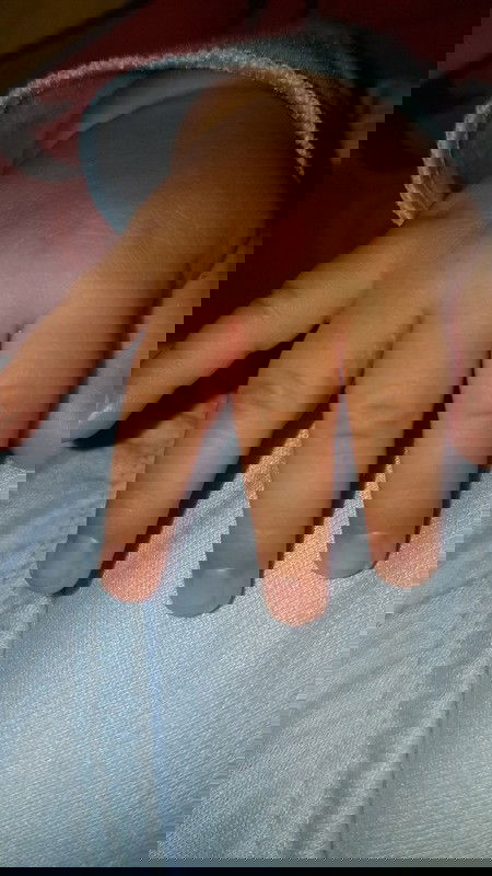 Ruam berbintik putih