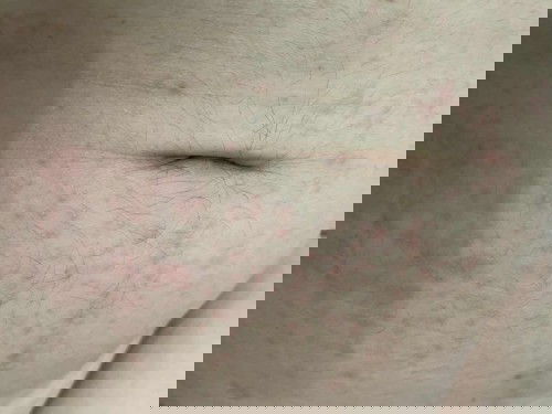 ผื่นคันเป็นเฉพาะที่ท้อง15วีค