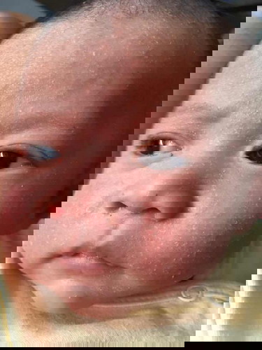 หน้าลอกเป็นขุย