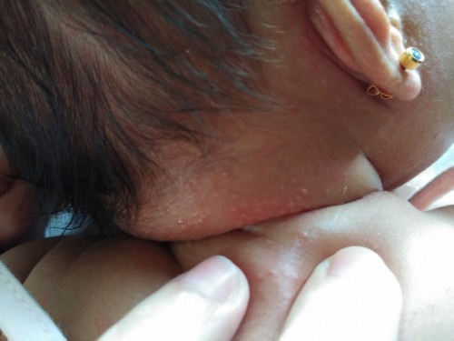 Rashes ni baby