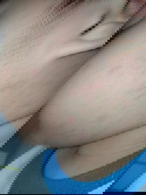 Tigdas Hangin ba ito or Bungang Araw