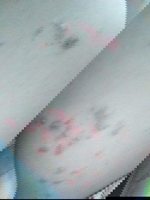 E đang bầu 27w mà bị zô na có bôi được thuốc k ạ. Hay có cách gì để trị khỏi k ạ.