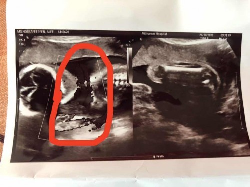 สายสะดือพันคอทารกในครรภ์