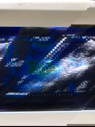 สับสนเกี่ยวกับอายุครรภ์ค่ะ