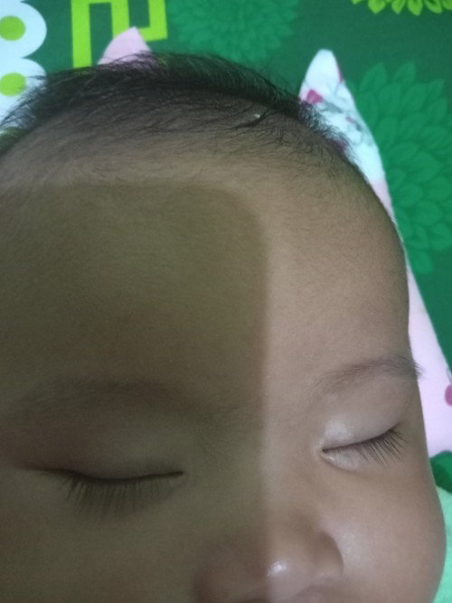 Bercak putih dimata