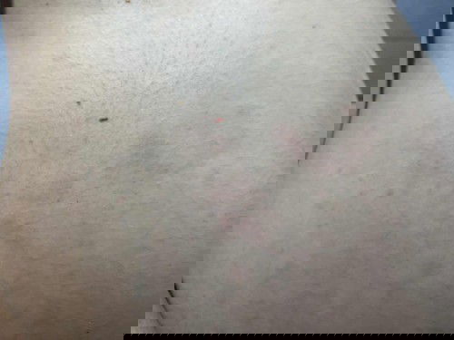 เป็นผื่นที่ท้อง ตั้งครรภ์ 26 สัปดาห์