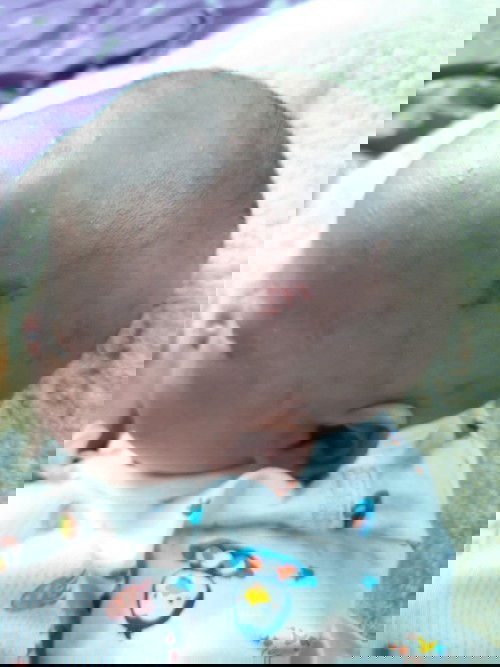 ลูกมีจ่ำแดงๆแบบนี้ปกติหรือป่าวคะ แรกๆมันเป็นจุดแดงเล็กๆนานไปมันชัดขึ้นใหญ่ขึ้น