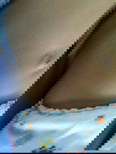 น้องเป็นตุ้มเล็กๆขึ้นที่ท้องค่ะ มีลูกแม่ๆท่านไหนเคยเป็นบ้างค่ะ ไม่รู้คือตุ่มอะไรค่ะ