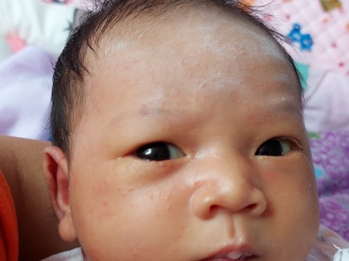 ผื่นขึ้นหน้าลูก